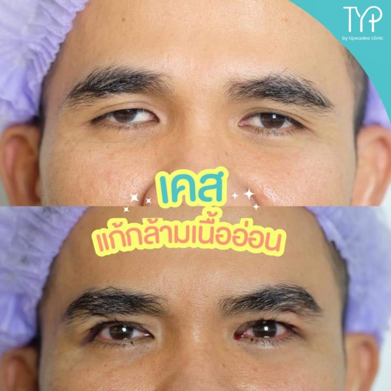 ตาสองชั้นแก้กล้ามเนื้อตาอ่อนแรง