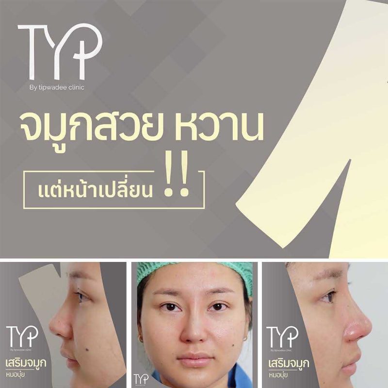 เสริมจมูกหาดใหญ่ by หมอบุ๋ย