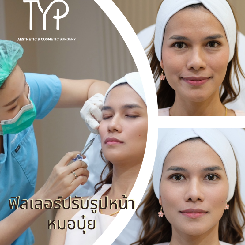 ฟิลเลอร์ปปรับรูปหน้า typclinic หาดใหญ่