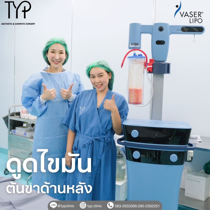 ดูดไขมันเครื่องVaser